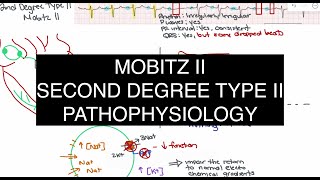 Understanding Mobitz Type II (Second-Degree Heart Block) – ECG Analysis & Pathophysiology