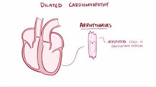 Dilated cardiomyopathy DCM   causes, symptoms, diagnosis, treatment & pathology