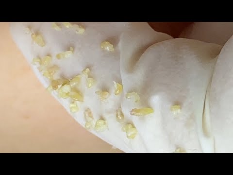 Video Removing Acne Hidden Under The Skin For Female Client... - youtube