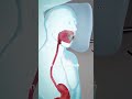 Endoscopic sleeve gastroplasty (3D animation) #slipdiscsurgery #3danimation #science #facts #drone