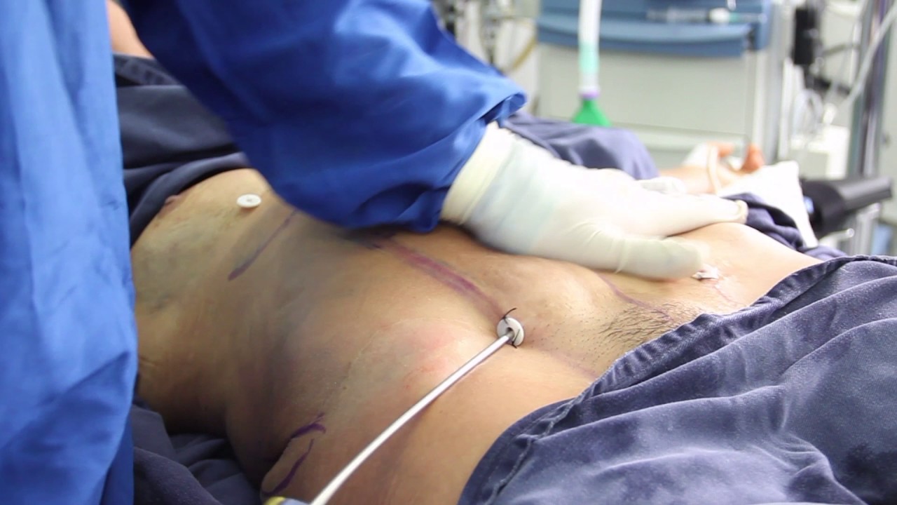 Marcacion abdominal antes y despues mujeres