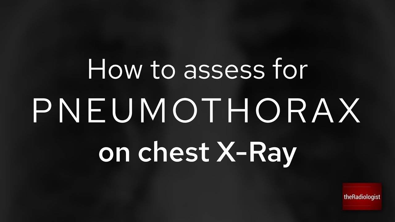 How to look for a pneumothorax on a frontal chest X-ray - YouTube