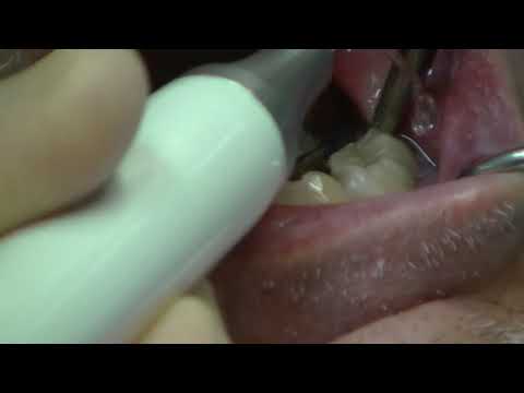 PiezoPro Plus Extraction and Grafting with OsteoGen Plug