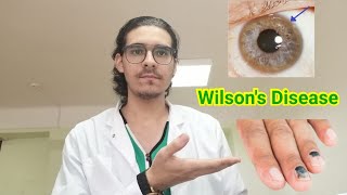 ما هو مرض ويلسون وأسبابه وعلاجه؟ - What is Wilsons disease, its causes and treatment