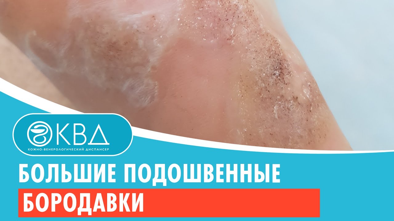 😐 Большие подошвенные бородавки. Клинический случай №208 - YouTube