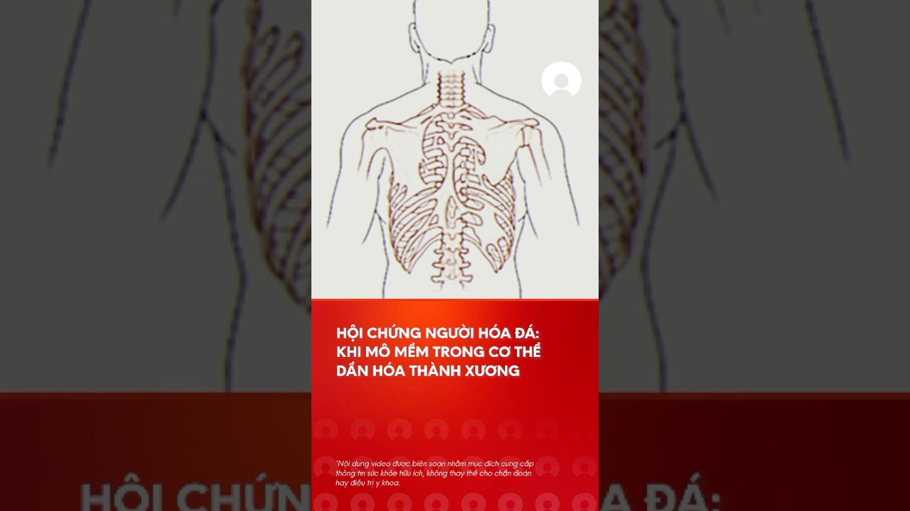 Há»™i chá»©ng "ngÆ°á»i hÃ³a Ä‘Ã¡" cá»±c hiáº¿m vá»›i tá»‰ lá»‡ 1/2.000.000 #facts