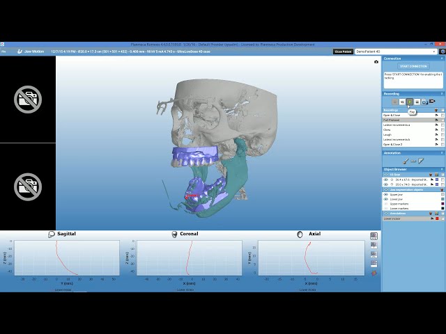 Planmeca Planmeca  4D™ Jaw Motion – Tutorial on Demo Case in Planmeca Romexis® 4.4