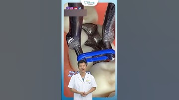 Cung Khẩu Cái Trong Niềng Răng | Nha Khoa Minh Châu