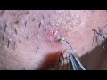 Plucking facial hair & ingrown hair 804 顎髭抜き(埋没毛あり)