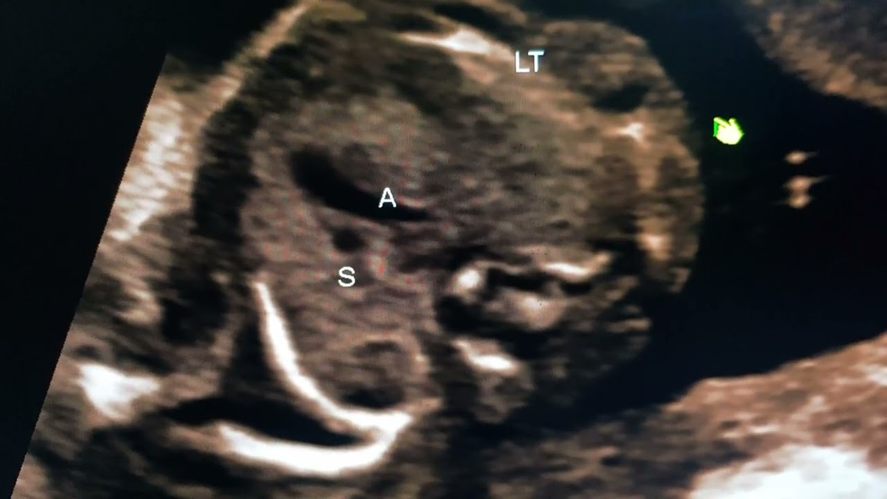 Трехстворчатая атрезия, HRHS, двойной выход левого желудочка, TGA. Преподавание доктора Прадипа Ш...