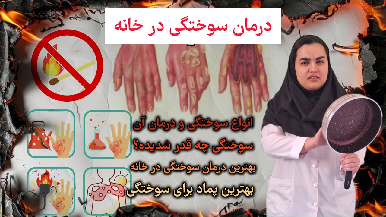 چه جوری سوختگی رو تو خونه درمان کنیم؟/رازهای درمان سوختگی 