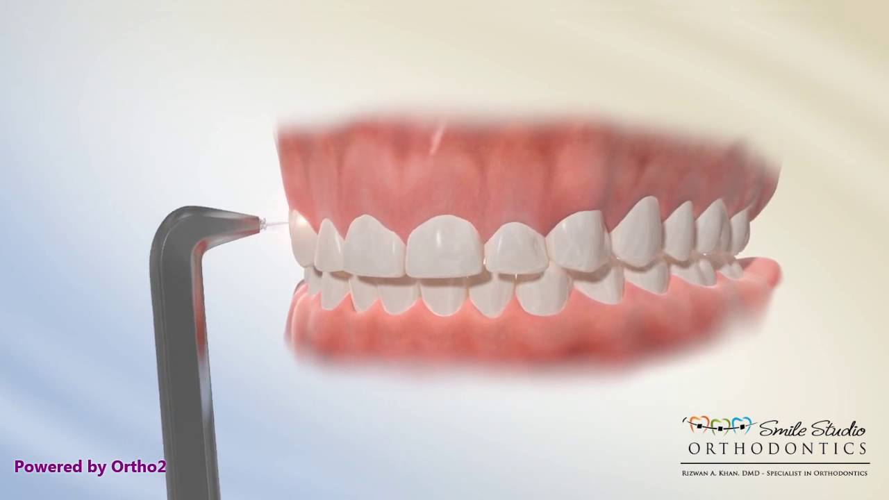 Laser Gingivectomy YouTube