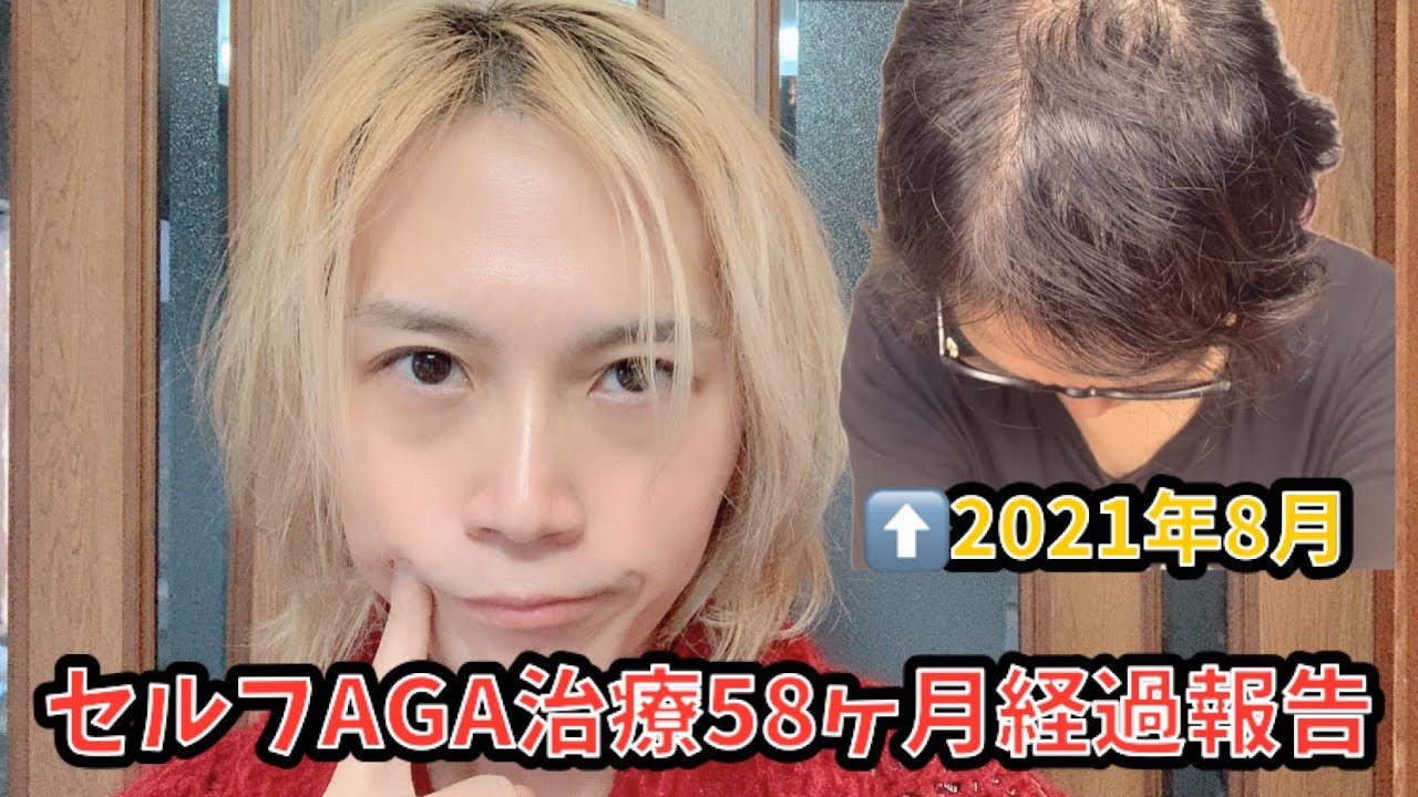 【別人レベル！】セルフAGA治療58ヶ月目経過報告 #薄毛治療 #aga治療 