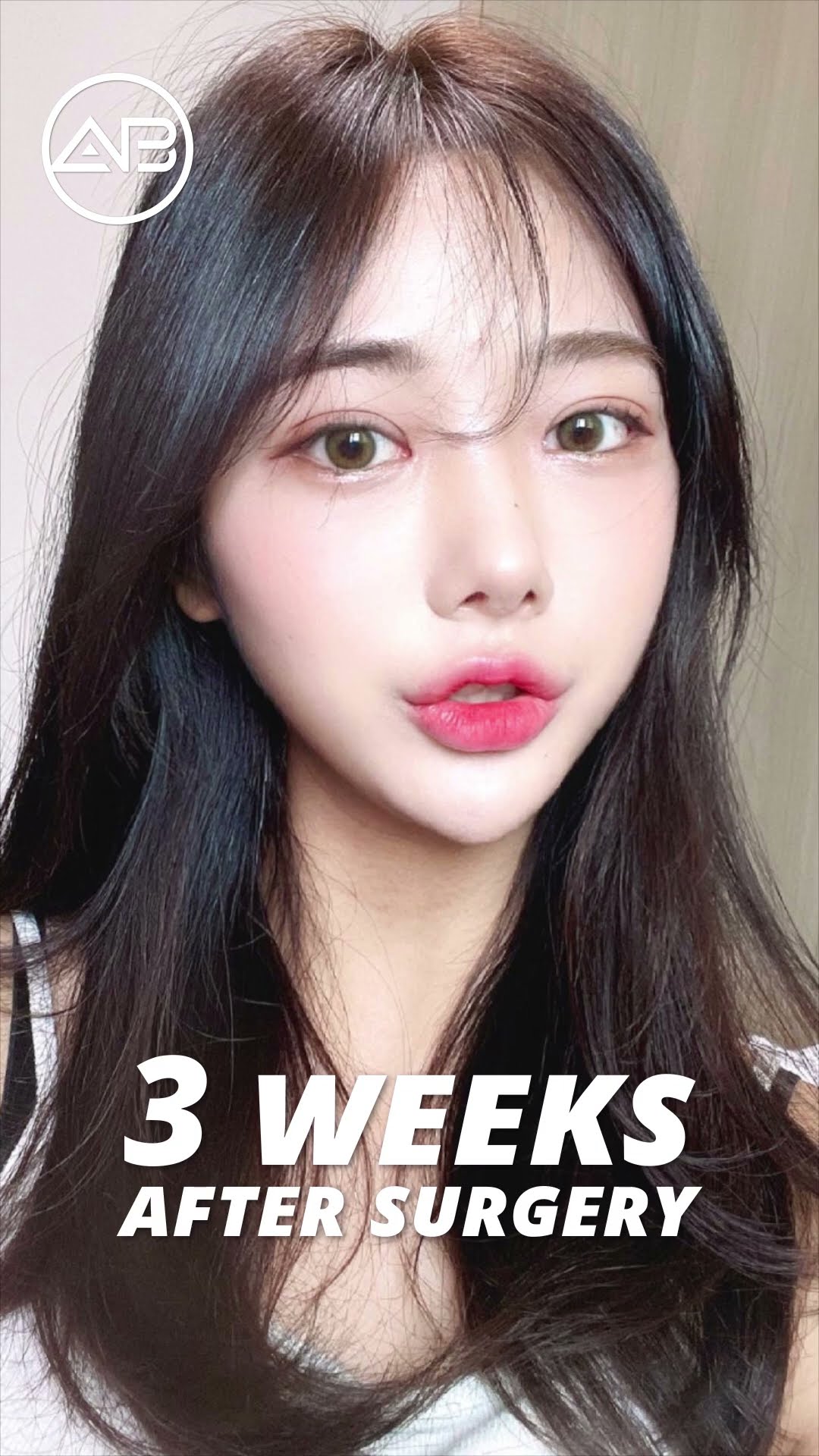[Plastic surgery in Korea] Eyes Revision + Epi Canthoplasty + Lateral Canthoplasty