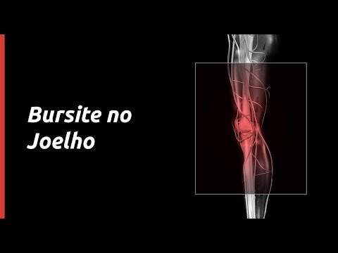 Vídeo: Bursite No Joelho - Sintomas, Tratamento, Causas