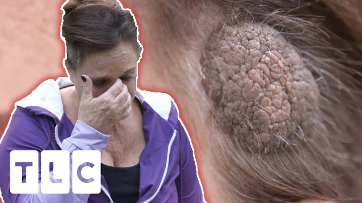 Wart On Debra's Head Wont Stop Growing! | Dr. Pimp...