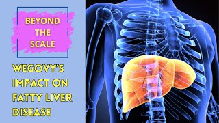 Wegovy and Fatty Liver Disease MASH A Game-Changer Plus My Week 21 22 Progress Update