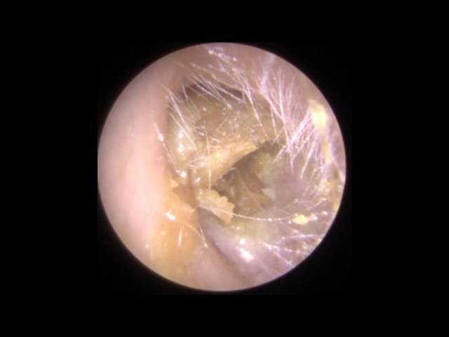 Ear Wax Removal (Endoscopic) | Clearwax - Ear Wax Removal Specialists class=