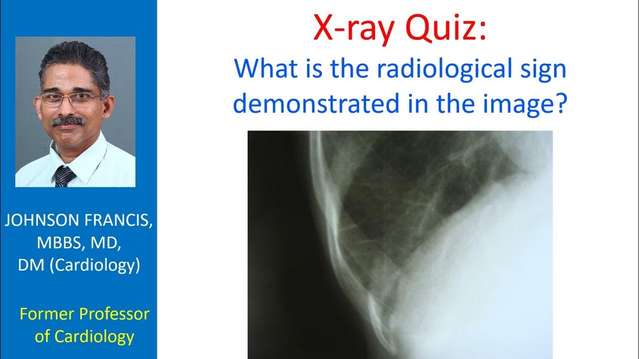 X ray Quiz What is the radiological sign demonstrated in the image