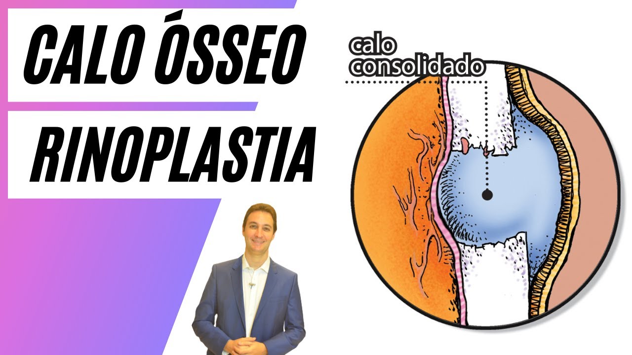 Calo osseo na rinoplastia