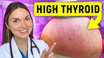 19 Signs of HYPERTHYROIDISM (Graves Disease) You Can See: Doctor Explains