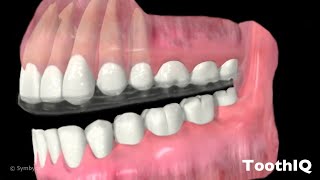 Occlusal Guards (1080p)