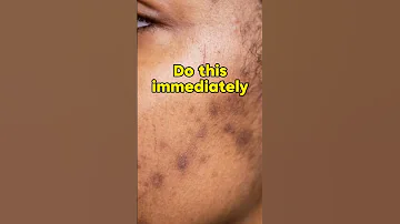 2 Steps To Reduce Acne Scars 