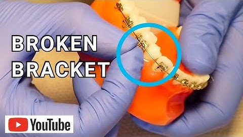 Broken Braces: Broken, Loose or Sliding Bracket| What To Do!