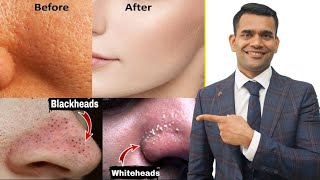 Blackheads, Whiteheads, Open Pores 100 % Working Home Remedy | How To Shrink Pores