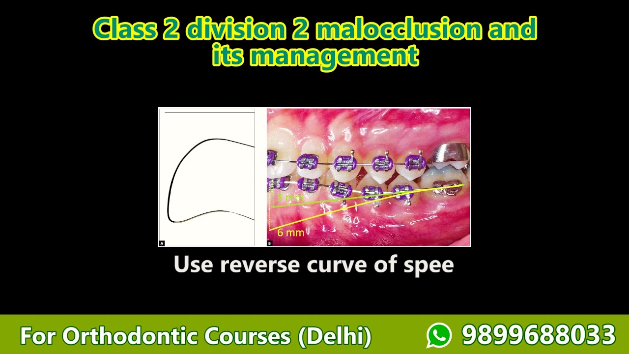 #orthodontics  #treatment  planning Part 4-  Class 2 div 2 malocclusion, Orthodontic Courses Lecture