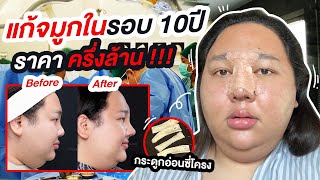 จ่ายครึ่งล้าน!! แก้จมูกในรอบ 10ปี ผ่าตัดนาน 9ชั่วโมง | จือปาก X เมโกะคลีนิค