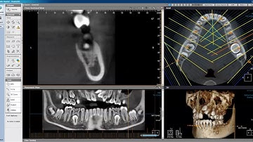 How to Create a Panoramic Curve in Xelis 3D Imaging Software