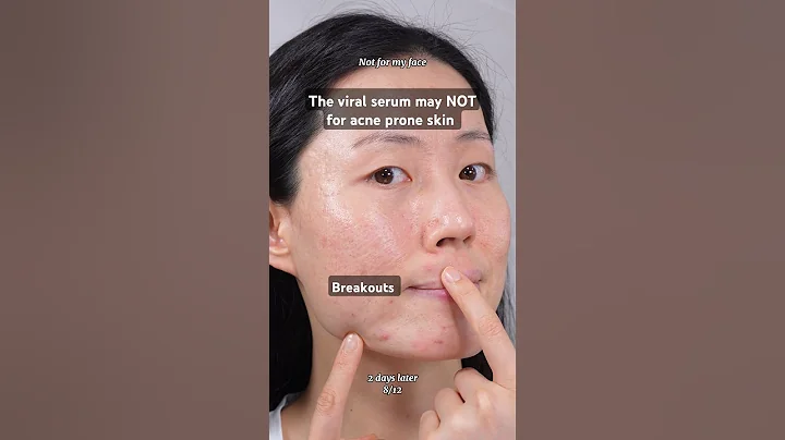 Is there any viral product giving you a breakout❓Anua Niacinamide+TXA serum #acneproneskin #pimple