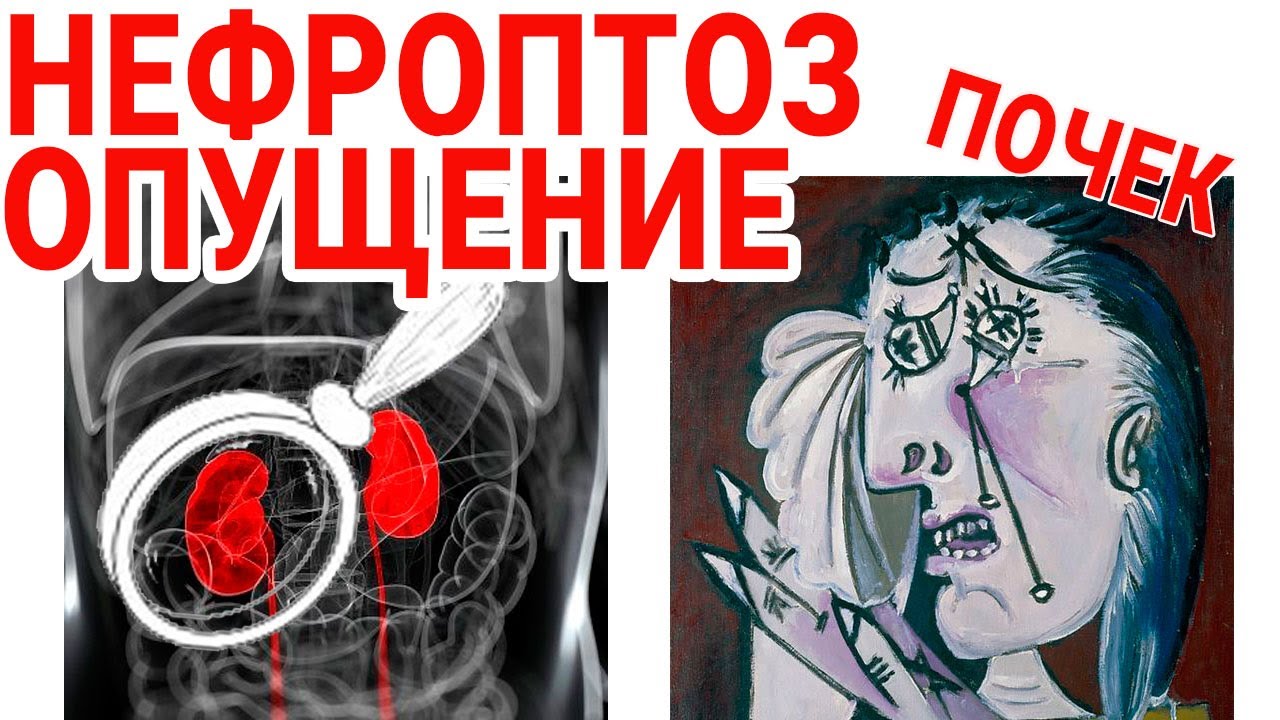 НЕФРОПТОЗ (ОПУЩЕНИЕ ПОЧКИ). Профилактика и Лечение ПОЧЕК ...