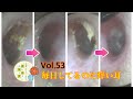 【耳掃除】Vol.53 奥に潜む耳垢 鼓膜の近くが、痒いんです。earcleaning&headspa Kaleidoscope tokyo