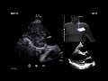 Vscan Air™ | Caption AI™ Prescriptive Guidance