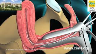Endometrial Biopsy (Hindi) - CIMS Hospital