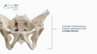 CurvaFix Low Profile System Introduction