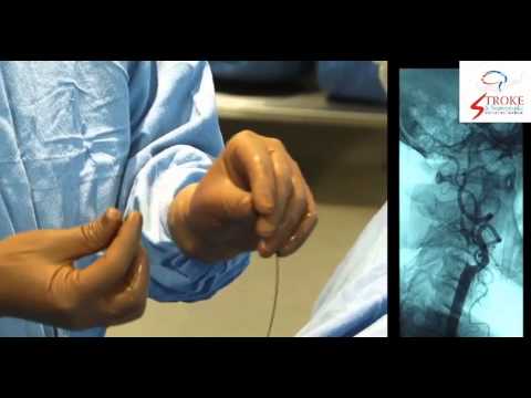 Video: Puas yog carotid artery stenting muaj kev nyab xeeb?