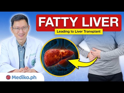 FATTY LIVER: Sanhi, Sintomas, at Lunas
