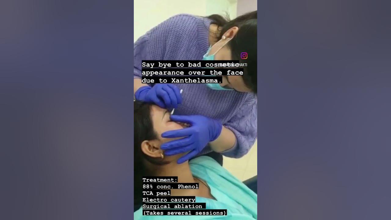 yellowish harmless crystals deposited over the eyelids or below it are