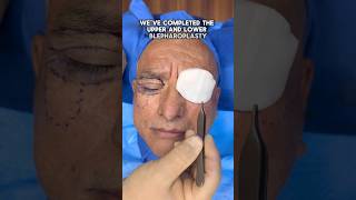 Upper &amp; Lower Blepharoplasty + Mid Facelift Under Local Anesthesia | 72 Year Old Male Transformation