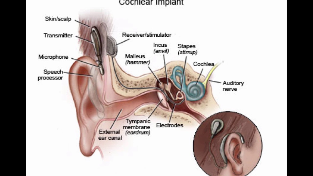 Cochlear Implant