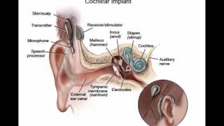 Cochlear Implants - Part 1
