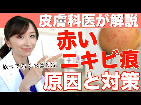 皮膚科医が教える赤いニキビ痕の治し方