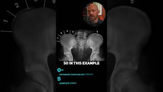 How Pelvic X-rays Help Predict Scoliosis Progression