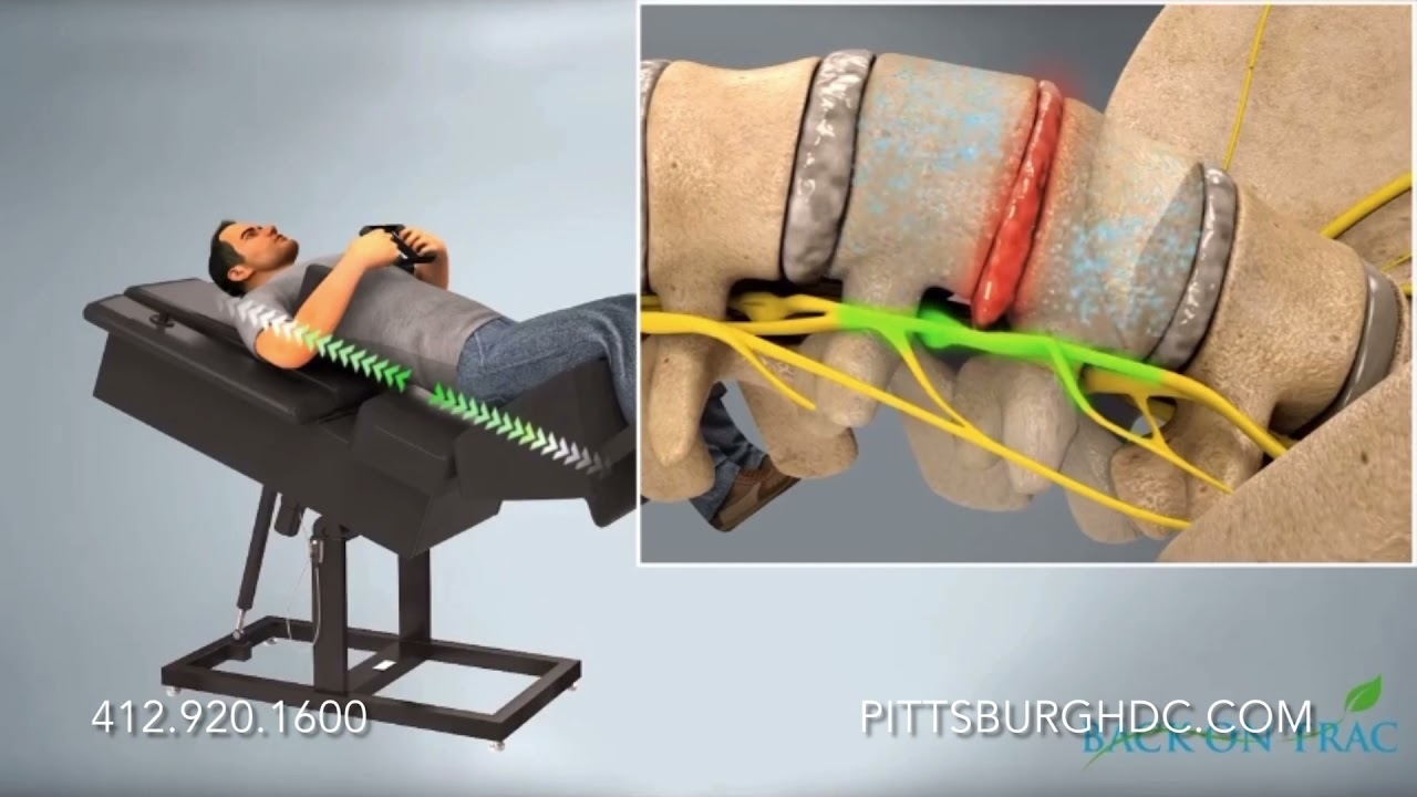 Chiropractor 412 | Avoid BACK SURGERY with Spinal Decompression! - Pittsburgh PA
