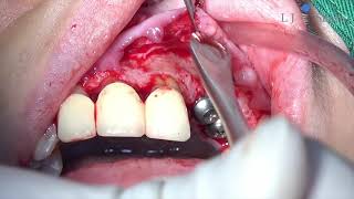 the tenting screw in vertical and horizontal bone augmentation
