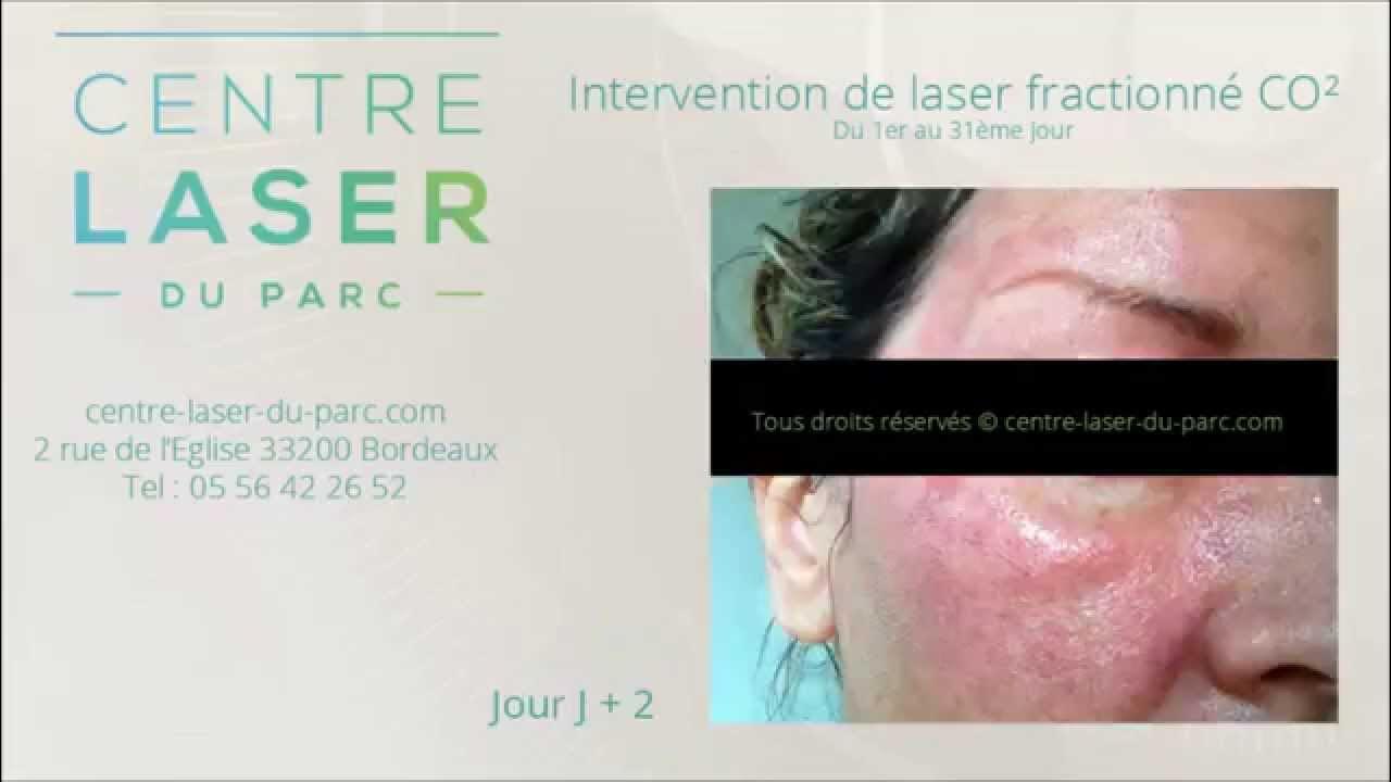 Laser CO² Fractionné étapes Intervention + 31 jours YouTube