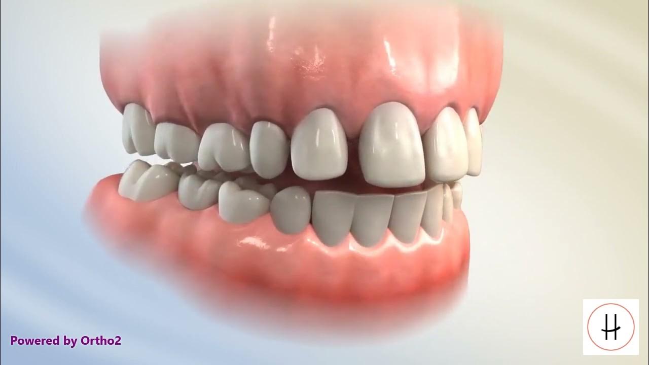 Tongue Tamers High Line Orthodontics New York, NY YouTube